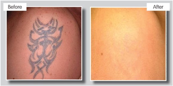 tattoo removal at suzanne's beauty in stoke