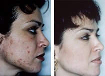 acne treatments with microdermabrasion