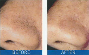 blackhead removal with microdermabrasion