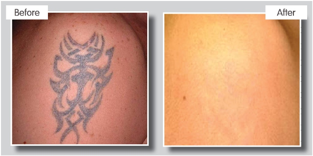 Safe tattoo removal with lasers at top Coventry Clinic