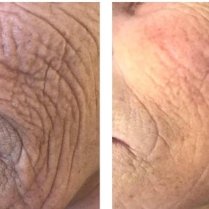 PLASMA PEN TREATMENTS IN COVENTRY AT SUZANNE'S BEAUTY CLINIC