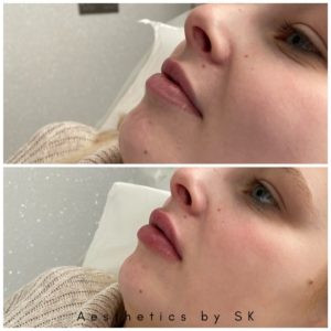 lip fillers before after at suzannes beauty clinic in Coventry lip fillers before after at suzannes beauty clinic in Coventry