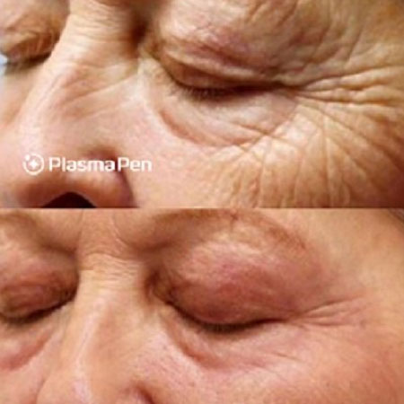 Plasma Pen Skin Tightening in Coventry at Suzanne's Clinic