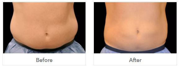 Before After Stomach Fat Reduction at Suzannes Beauty Salon in Coventry