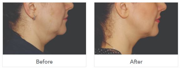 before and after double chin reduction at Suzannes Beauty Salon in Coventry