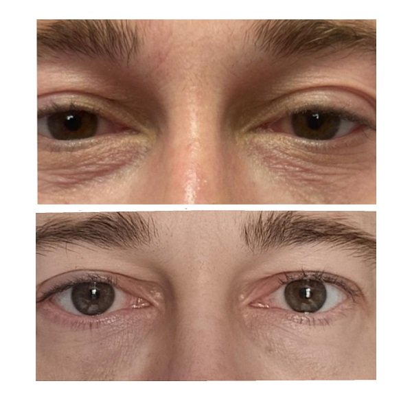 lumi eye injections in Coventry