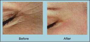 anti-ageing microdermabrasion at Suzanne's Beauty in Stoke