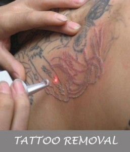TATTOO-REMOVAL