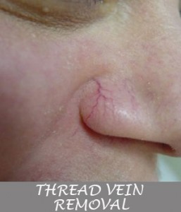 THREAD-VEIN-REMOVAL