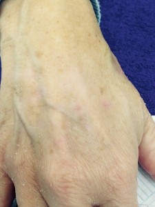 age spot removal, coventry beauty salon