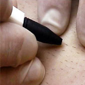 electrolysis, Stoke beauty clinic