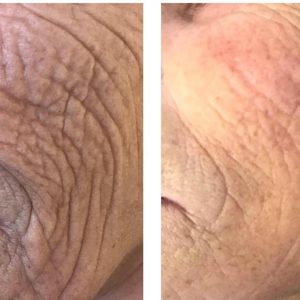 PLASMA PEN TREATMENTS IN COVENTRY AT SUZANNE'S BEAUTY CLINIC PLASMA PEN TREATMENTS IN COVENTRY AT SUZANNE'S BEAUTY CLINIC