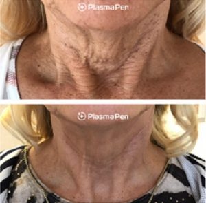 PLASMA PEN TREATMENTS IN COVENTRY AT SUZANNE'S BEAUTY CLINIC PLASMA PEN TREATMENTS IN COVENTRY AT SUZANNE'S BEAUTY CLINIC
