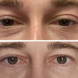 lumi eye injections in Coventry