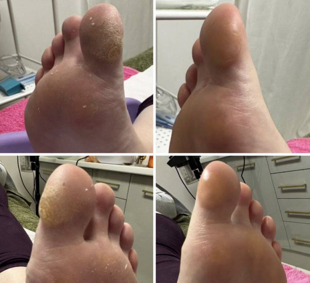 callus removal in Coventry 