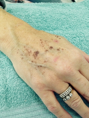 Laser treatments for age spots in Coventry