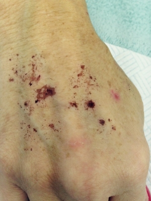Laser treatments for skin pigmentation in Coventry