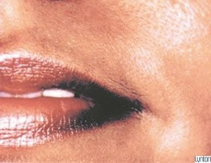 ipl-hair-removal-after